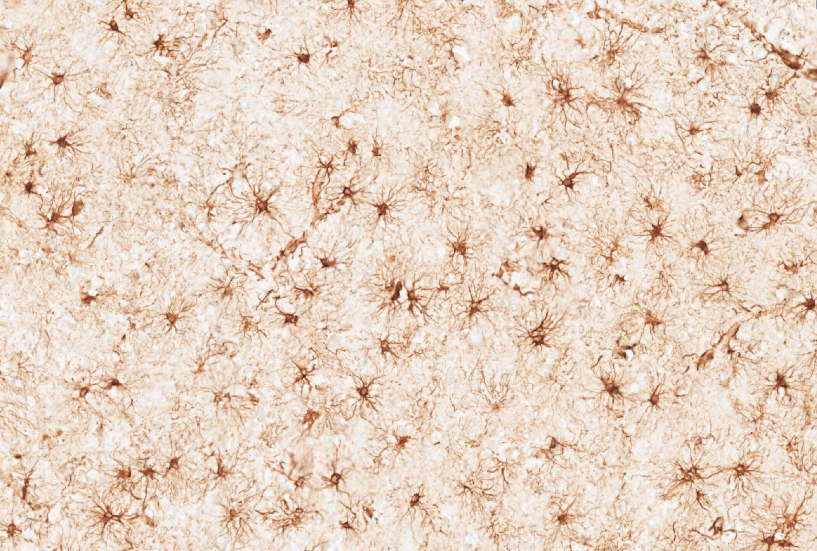 Reactive astrocytes in Ischemic stroke - GFAP IHC